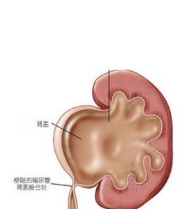 胎兒雙腎積水