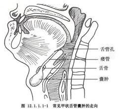 甲狀腺舌管囊腫切除術