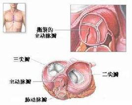 主動脈弓置換術