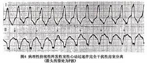 病理性陣發性室性心動過速