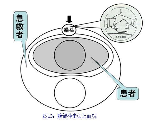 急性呼吸道堵塞