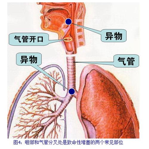 急性呼吸道堵塞