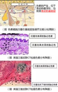 美國三維皮膚CT檢查色素陣圖