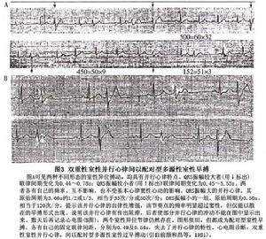 室性並行心律及室性並行心律性心動過速