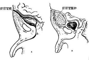 臍尿管囊腫