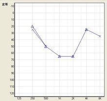 盆狀聽力圖多見於遺傳性聽力損失