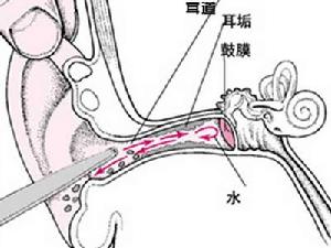 鼓膜修補術