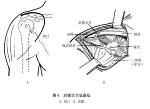 肩鎖關節脫位