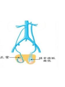 精索靜脈曲張顯微鏡手術