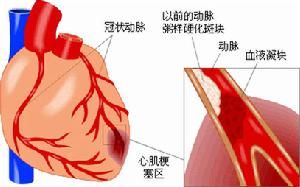 梅毒性心臟病