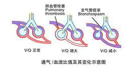 通氣血流比例