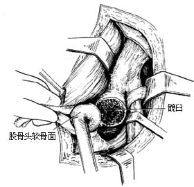 髖關節結核