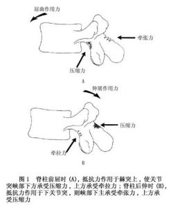 （圖）腰部峽部崩裂和脊椎滑脫