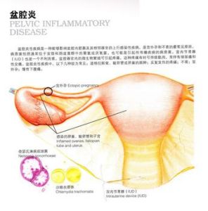 慢性附屬檔案炎