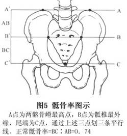 新生兒肛門和直腸畸形