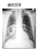 氯甲醚肺癌空洞