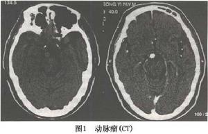 （圖）腦內動脈瘤