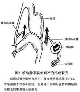 胃切除術後內疝