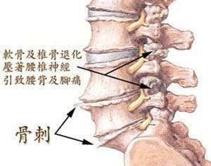 骨質增生效果圖