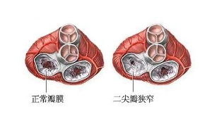 瓣膜病