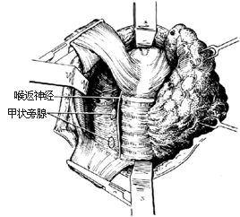 甲狀腺全部切除術