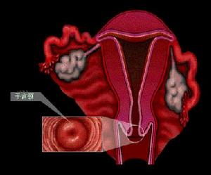 急性宮頸炎