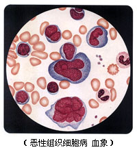 惡性組織細胞病