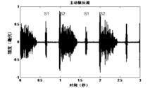 圖5 主動脈反流（主動脈關閉不全）的心音