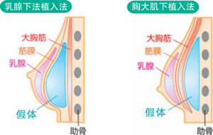 假體植入豐胸