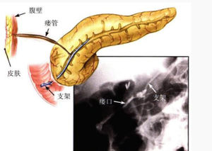 胰十二指腸切除術