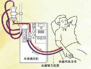 慢性腎功能衰竭