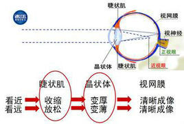 近視眼恢復