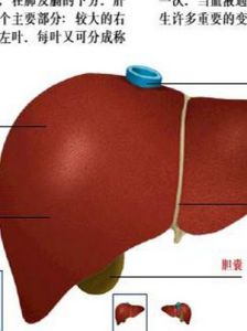 膽汁性肝硬化