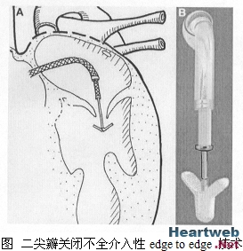 風濕性二尖瓣狹窄