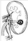 腎竇內腎盂切開取石術