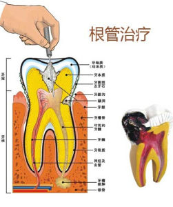 根管治療術