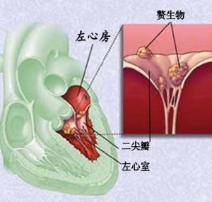 感染性心內膜炎