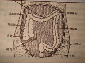 左半結腸癌