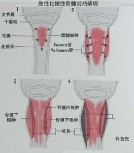 先天性脛骨缺如