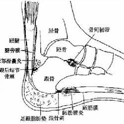 跟骨骨膜炎