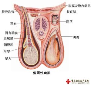 假兩性畸形