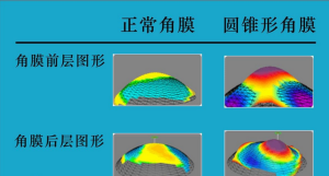 近視眼雷射手術