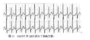 QRS與T波電交替