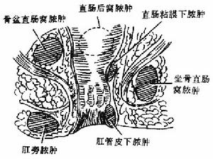 直腸肛管周圍膿腫