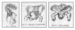 狹窄骨盆