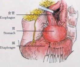 膈肌疾病