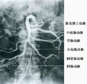 腸系膜上動脈栓塞