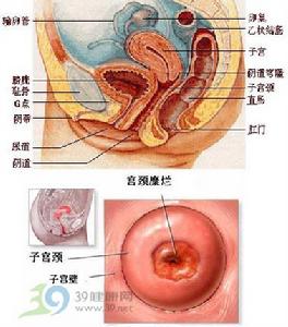 （圖）宮頸糜爛引起出血