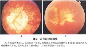 變性近視的脈絡膜萎縮