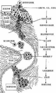 腫瘤分期